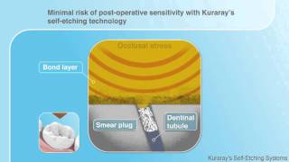 Kuraray Selfetch demonstration  dental use [upl. by Annawal272]