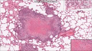 Tuberculosis Granulomas  Histopathology slides [upl. by Naedan]