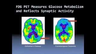 Diagnosis of Alzheimers Disease [upl. by Nosemyaj865]