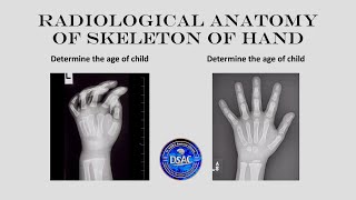 Age estimation from X Ray Radiological anatomy of hand Ossification of carpal amp metacarpal bones [upl. by Pestana]