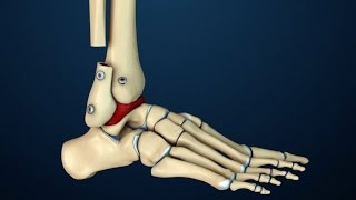 Arthrodesis  Transfibular Ankle Fusion Surgery  Nucleus Health [upl. by Ecienal878]