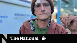 How a fleshrotting ‘zombie drug’ is complicating the overdose crisis [upl. by Rhoades]