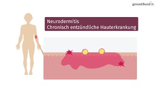 Was ist Neurodermitis und wie kann man sie behandeln [upl. by Botti]