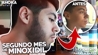 SEGUNDO MES USANDO MINOXIDIL  TRATAMIENTO PARA LA BARBA [upl. by Solracsiul]