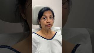 How Old is She 😳 Plastic Surgery Transformation facelift [upl. by Airamahs]