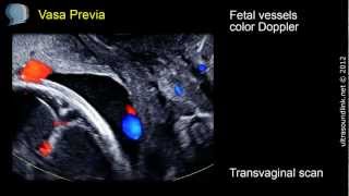 Vasa Previa  ultrasound diagnosis [upl. by Sallyanne]