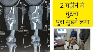 घुटना जाम नही होगा अगर सही इलाज हो। tibia bone knee condyle fracture recovery in 2 months [upl. by Suirred]