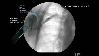 Arrow® EZIO® System  Proximal Humerus Infusion Fluoroscopy Adult Alert Patient [upl. by Notsyrb]