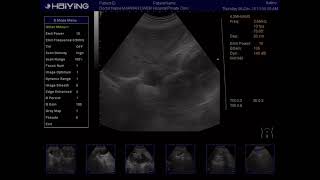 Ultrasoundtwisted abdominal aortatortuous aorta [upl. by Eisus]