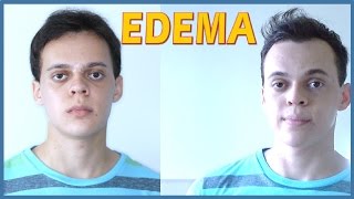 Edema  Minha Cirurgia Ortognática [upl. by Pagas]