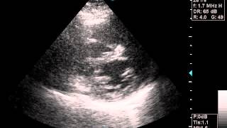 Echocardiography pulmonary hypertension [upl. by Suoirtemed295]