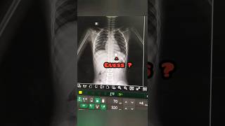 Abdomen Xray  Foreign Body Xray shortsfeed viral ytshorts [upl. by Ahsap212]