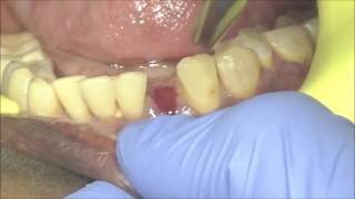 Single lower incisor extraction and immediate basal implant procedure surgery video [upl. by Annaes]