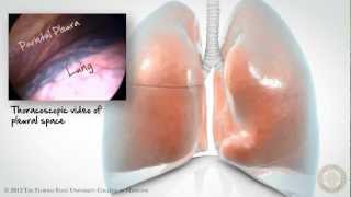 Pleural Space Part 1 of 3 HD [upl. by Jim]