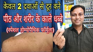 काले धब्बे कैसे मिटाए How to get rid of black spot in hindi how to cure liver spot easily in hindi [upl. by Herzen]