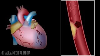 Myocardial Infarction and Coronary Angioplasty Treatment Animation [upl. by Lazare]