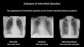 How to Interpret a Chest XRay Lesson 7  Diffuse Lung Processes [upl. by Einomrah]