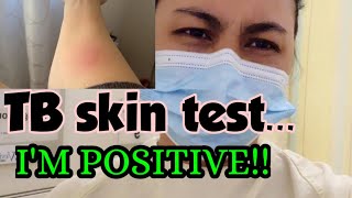 Life in Canada Nagpositive ako sa TB skin test [upl. by Angelina]