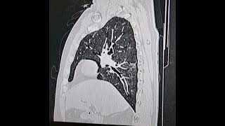 Desquamative interstitial pneumonia Coronal and sagittal images images [upl. by Gnehs]