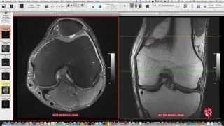 Systematic Interpretation of Knee MRI How I do it [upl. by Cavan]