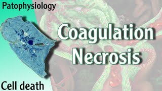 Pathophysiology  Coagulation Necrosis Hani Laith شرح [upl. by Alyl]