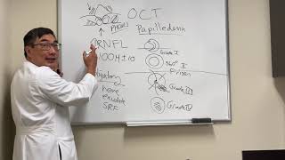 OCT in papilledema [upl. by Boyd]