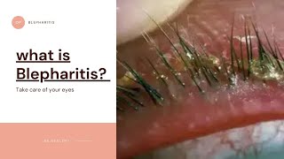 What is Blepharitis Dandruff in eyelid causes symptoms Treatment [upl. by Nahguav]