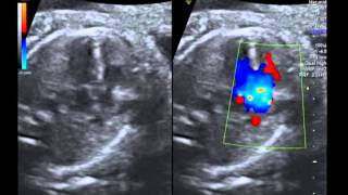 Common arterial trunk truncus arteriosus 5 chamber view with colour [upl. by Slavic866]