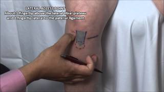 Knee Injection  Anterior Approach [upl. by Lacee]