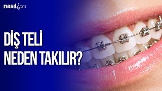 Diş teli neden takılır  Sağlık  Nasilcom [upl. by Yrolg502]