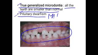 Microdontia [upl. by Barsky823]