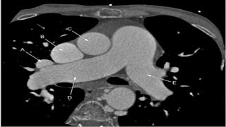 Cardiac ampchest pulmonary anatomy 6frcrradiologyanatomyradiopediamrichest xraymrictexams [upl. by Rosalinda]