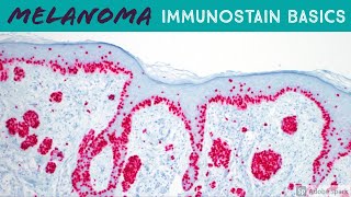 Melanoma Immunohistochemistry Basics Melanoma In Situ vs Solar Lentigo  5Minute Pathology Pearls [upl. by Lathe]