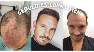 Die Höhen und Tiefen nach einer Haartransplantation [upl. by Yrebmik173]