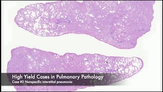 High Yield Pulmonary Case 2 Nonspecific interstitial pneumonia [upl. by Esyli]