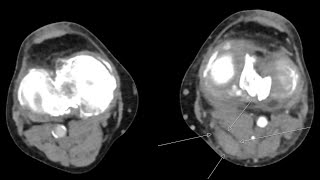 Gastrocnemius rupture mimicking acute vascular emergency [upl. by Bainbridge212]