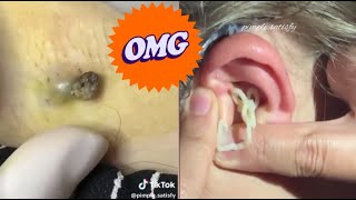 Blackhead Popping Extravaganza Satisfying Skin Care Moments [upl. by Naitsyrk]