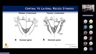 Indications Neurogenic Claudication amp Lateral Recess Stenosis  Phil Fagan MD [upl. by Etana]