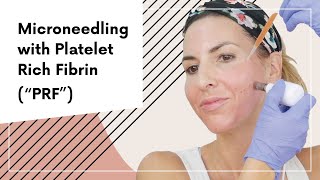 Microneedling with Platelet Rich Fibrin “PRF” [upl. by Renault]