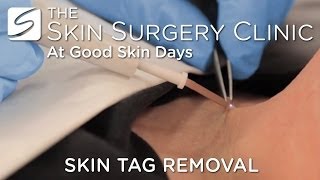 Skin Tag Removal  Watch the Procedure [upl. by Monafo]