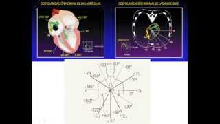 CRECIMIENTO DE CAVIDADES Y TRASTORNOS DE CONDUCCIÓN INTRAVENTRICULAR 1ª PARTE [upl. by Anihpled]