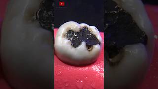 Restauración dental satisfying [upl. by Uaeb]