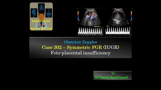 Ultrasound Case 302  Symmetric IUGR  Fetoplacental Insufficiency [upl. by Liahkim]