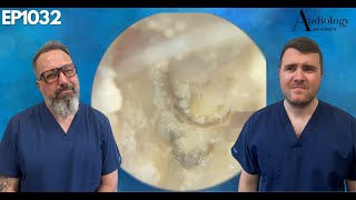 Removing a FUNGAL INFECTION from someones EAR CANAL  EP1032 [upl. by Ynor]