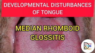 MEDIAN RHOMBOID GLOSSITIS  DEVELOPMENTAL DISTURBANCES OF TONGUE [upl. by Atnamas]