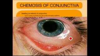 ENDOPHTHALMITIS SIMPLIFIED [upl. by Devonne]