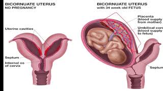 Congenital Uterine Anomalies part 2  Septate and Bicornuate Uterus  Sonographic Features [upl. by Ruperta30]