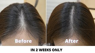 Simple home remedies to prevent hair loss and regrow hair naturally in 2 weeks I Stop hair fall 2021 [upl. by Estrin]