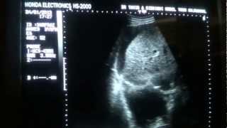 ASCITIC vs PLEURAL FLUID differentiation by ultrasound [upl. by Adianes748]