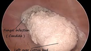 Removal of left over cotton bud  Q Tip   It causes Fungal infection with minute perforations [upl. by Etnoval]